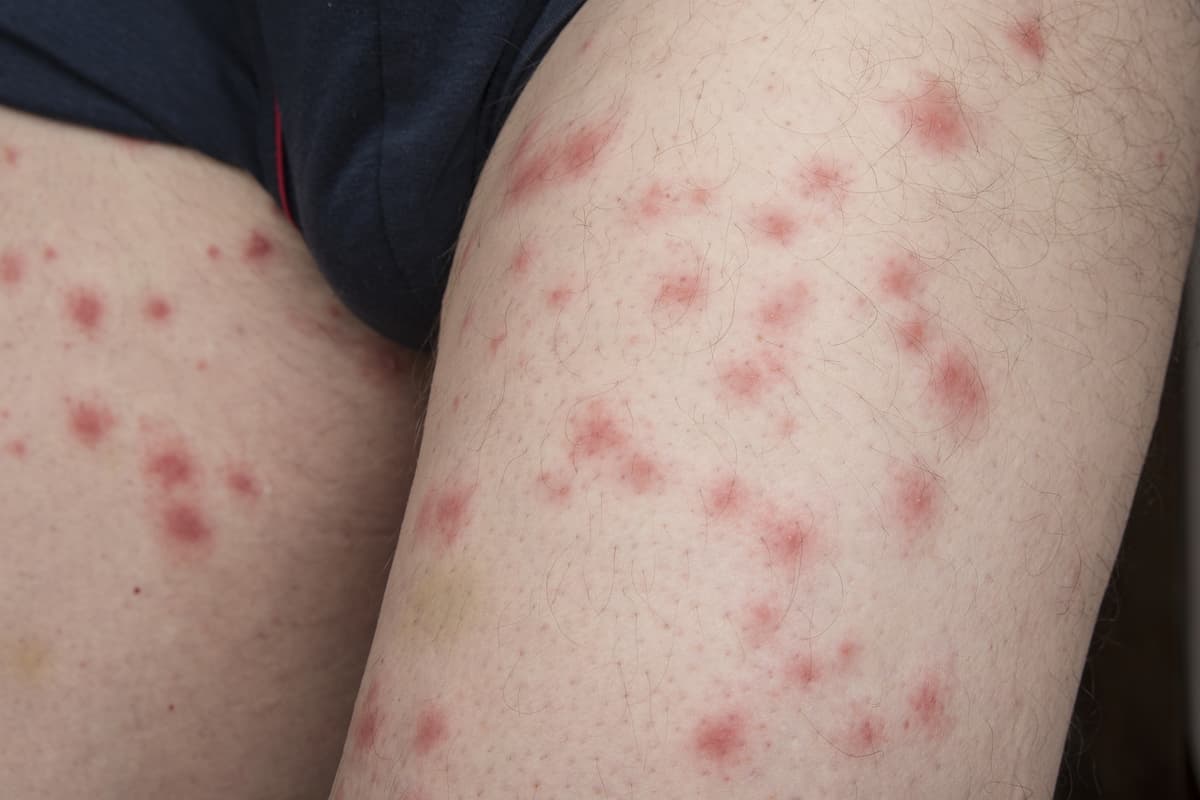 Photo of bed bug bites on a person's body.