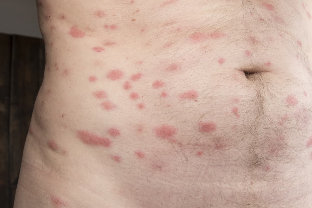 A bed bug bites on a man's body. 